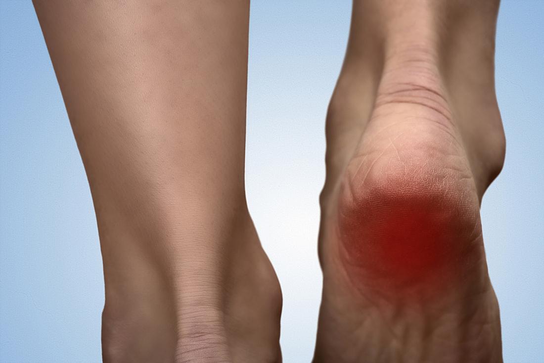 Heel spurs: Symptoms, risk factors, and 