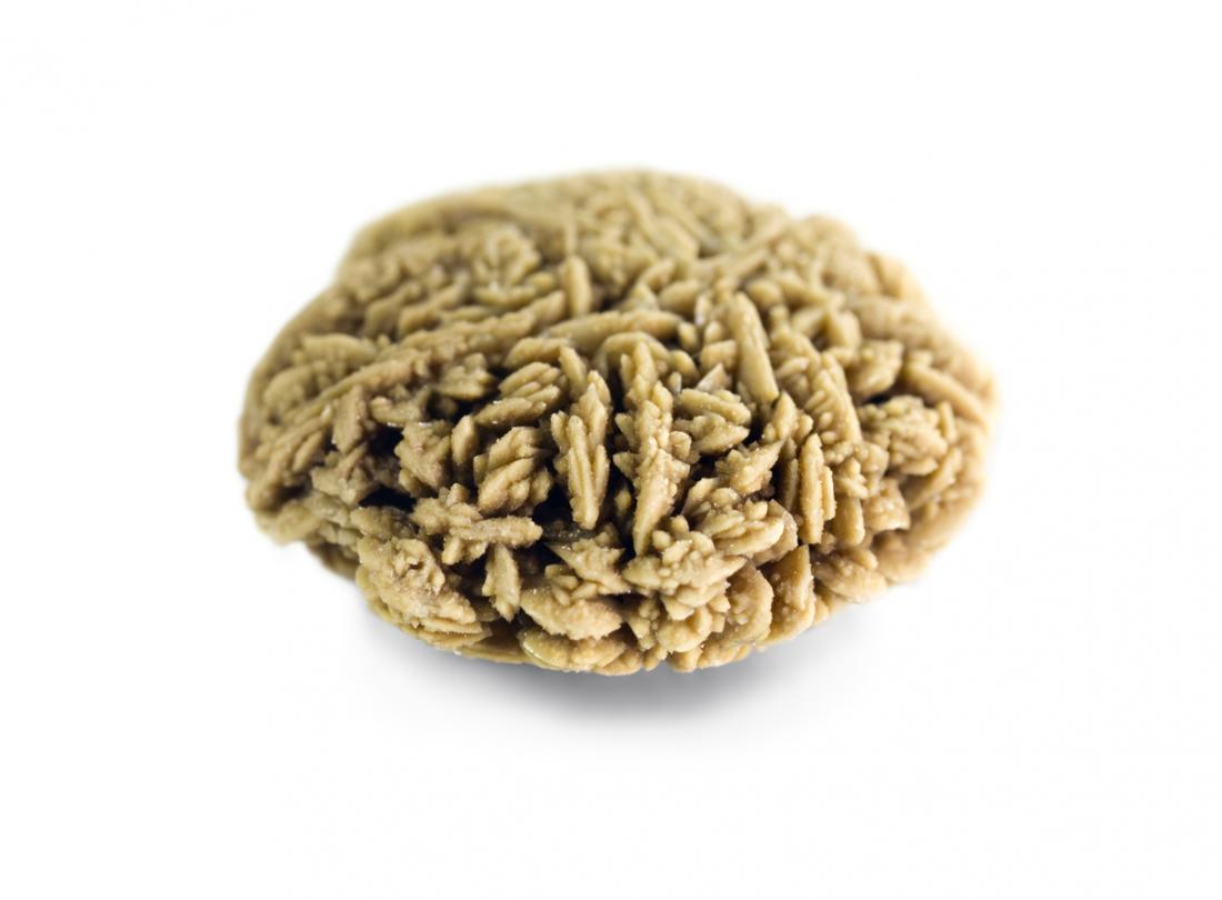 kidney stone close up