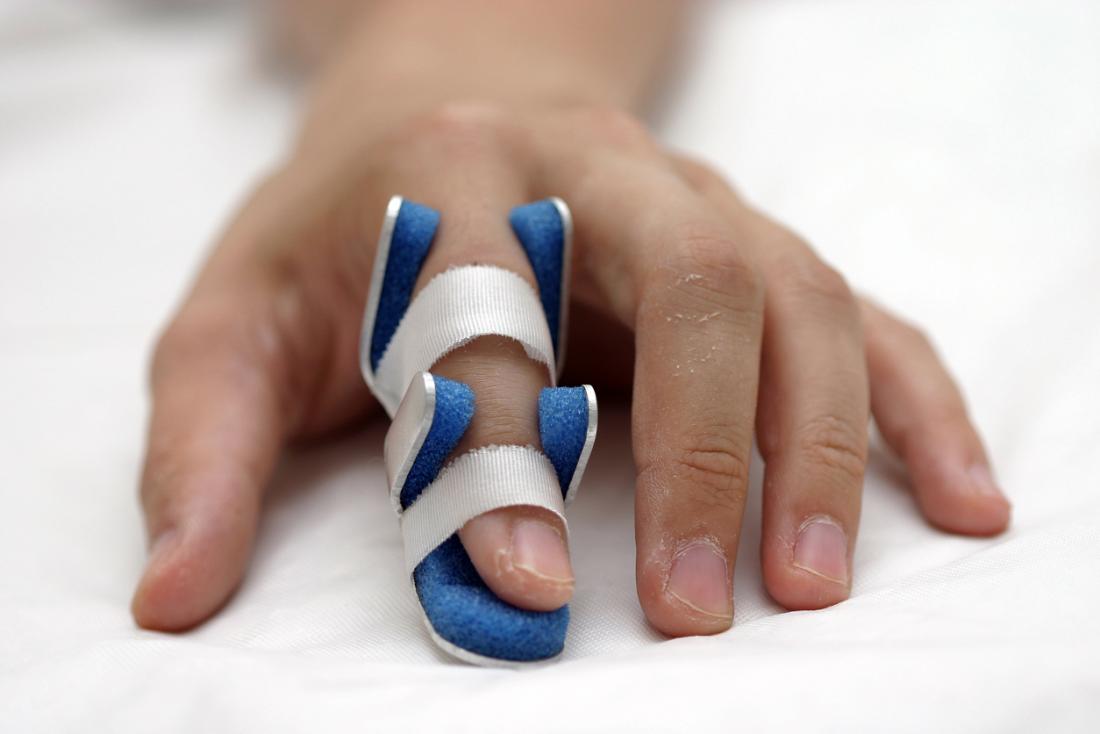 Sprained finger Symptoms, treatment, and recovery