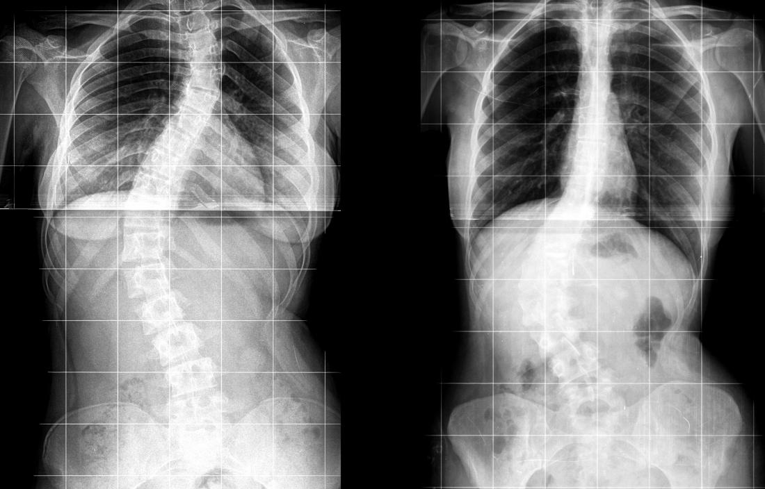 mild scoliosis x ray