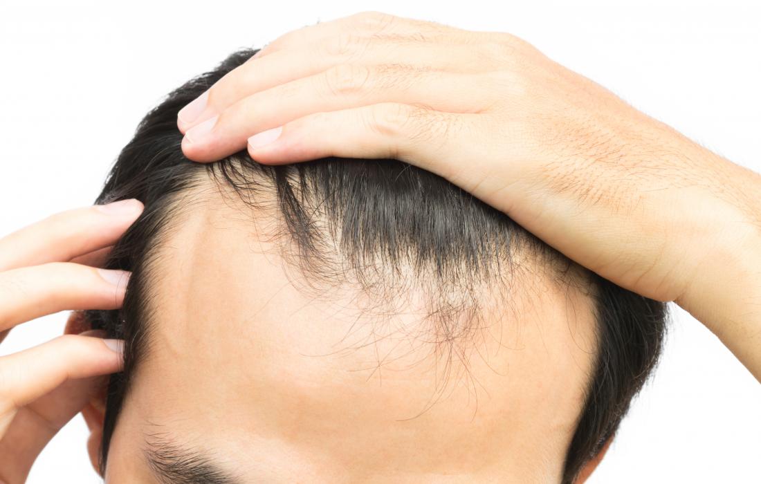 What to use for receding hairline