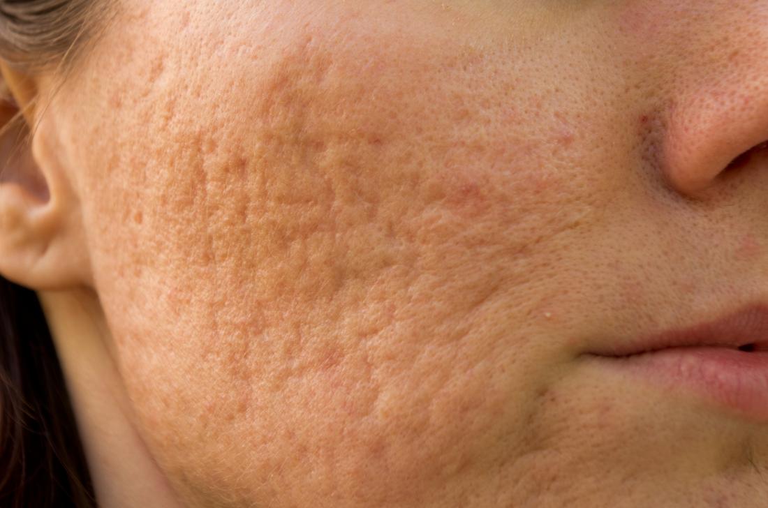 pockmarks as a result of acne scars on persons cheek.
