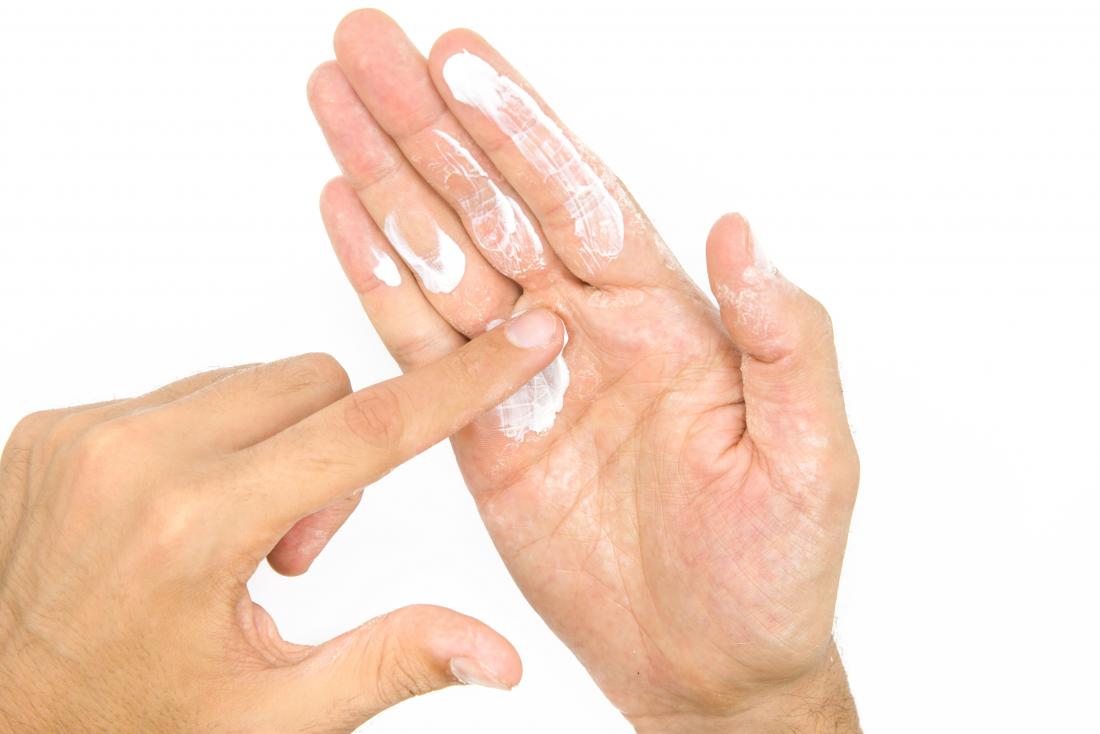 Person putting moisturizing lotion on dry skin on hands.