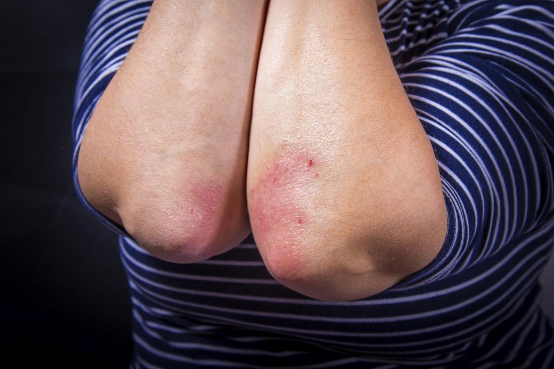 Psoriasis spread from one elbow to another elbow on the same person.