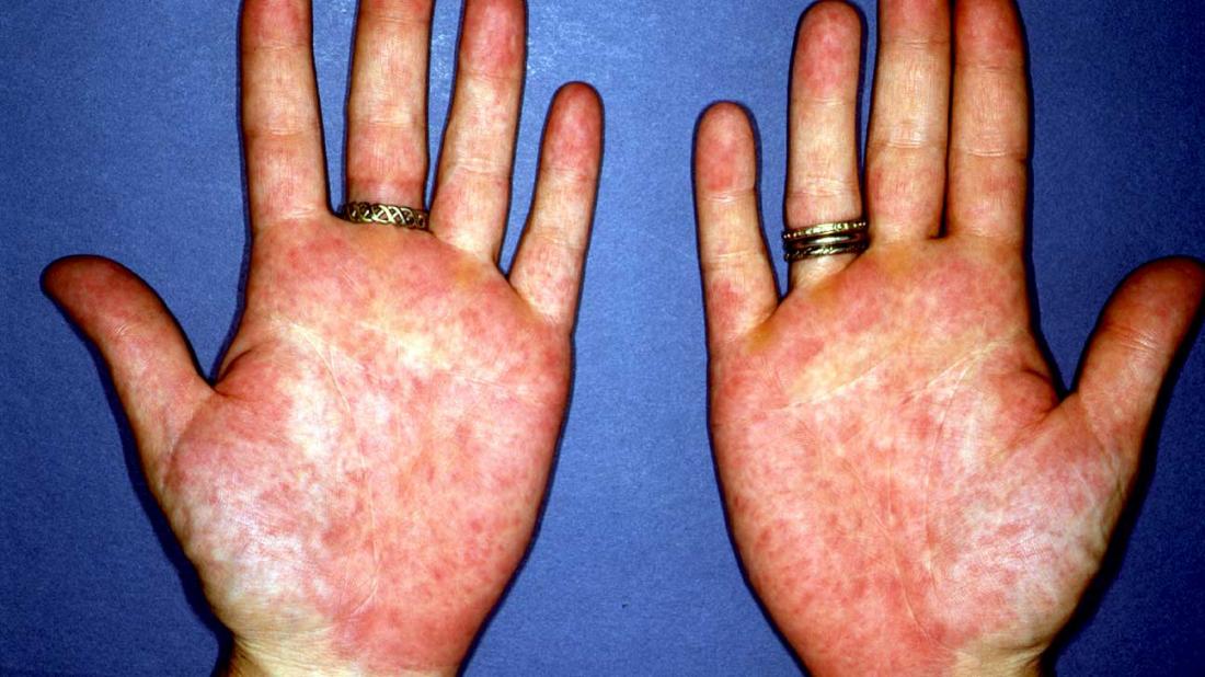 rash-on-palms-of-hands