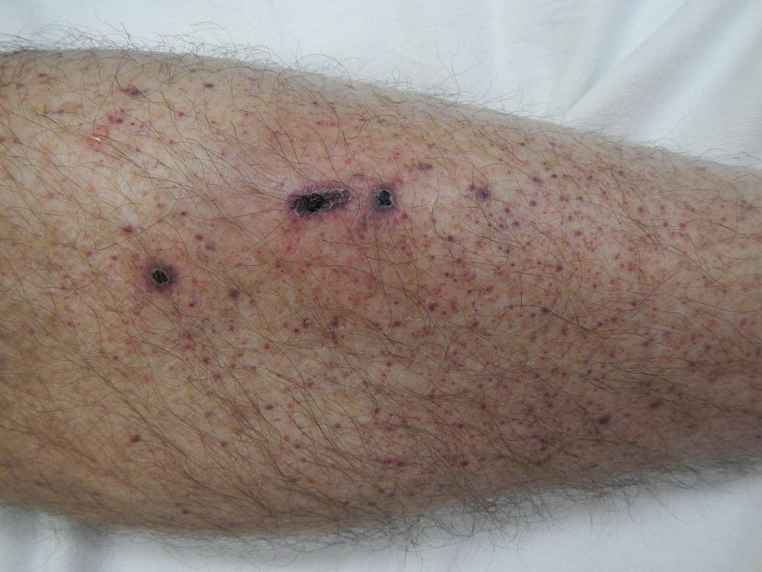 Petechiae: Causes, treatments, and pictures