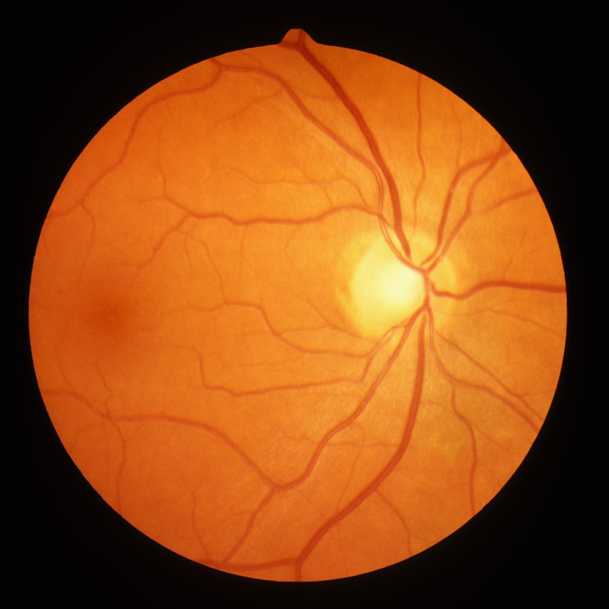 eye retina
