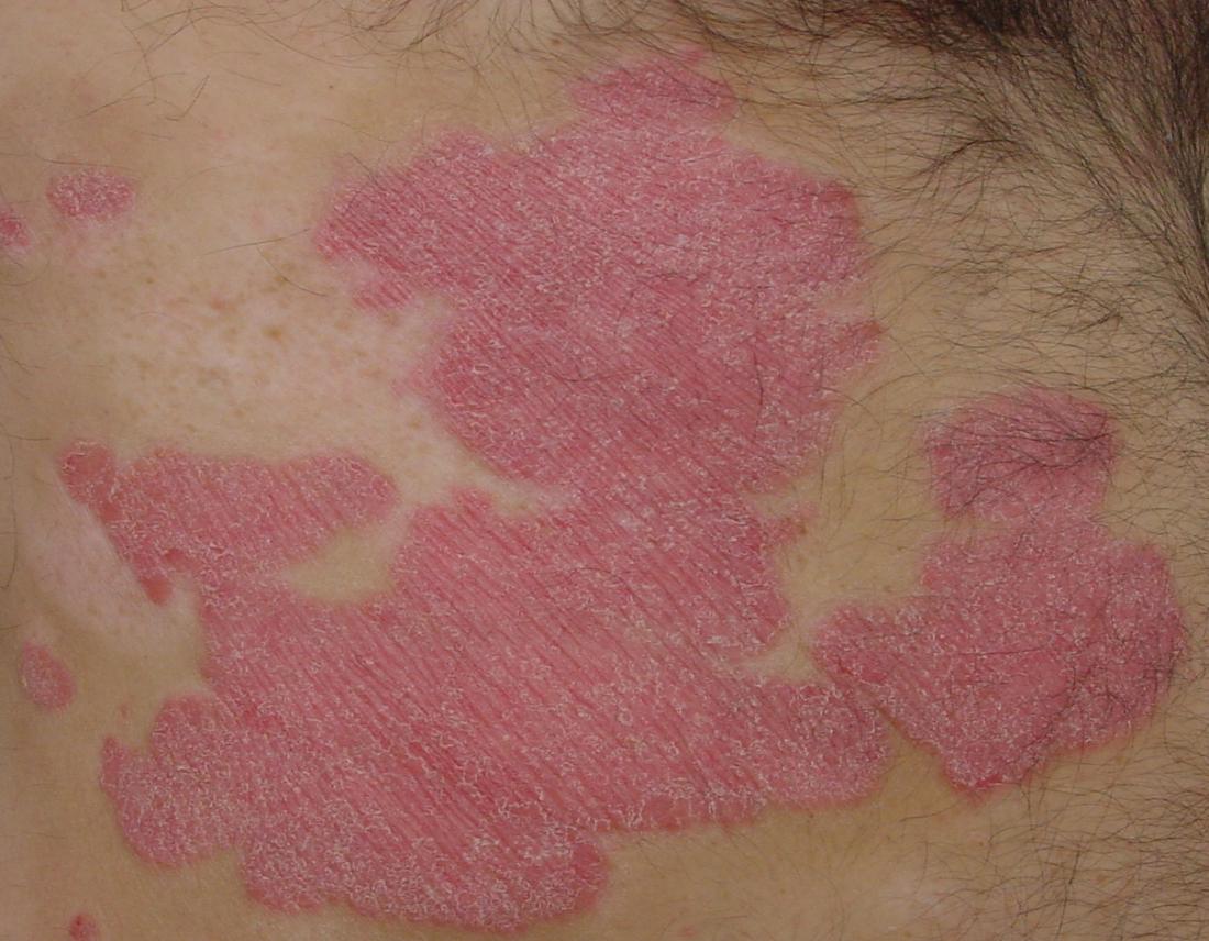 Plaque psoriasis