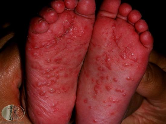 Pustular psoriasis on child's feet.