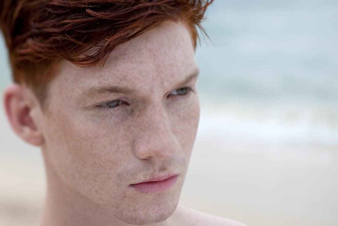 Fitzpatrick skin type 1, pale skin, freckles, red hair.