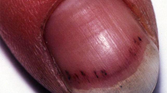 black-line-on-the-nail-causes-treatments-and-pictures