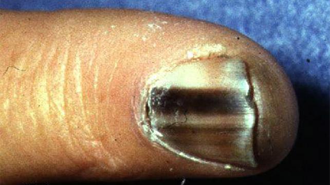 Black Fingernail - Symptoms, Causes & Treatment