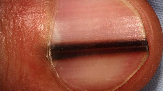 3 Causes Of Dark Skin Around Nails