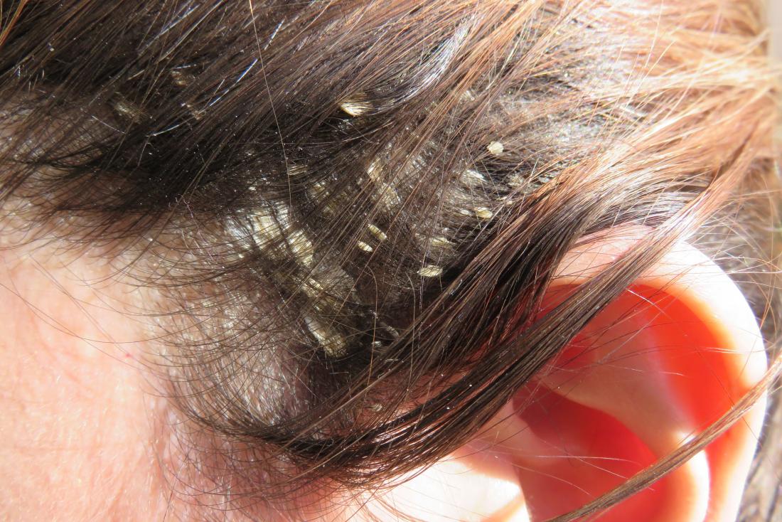 Eczema en el cuero cabelludo: y