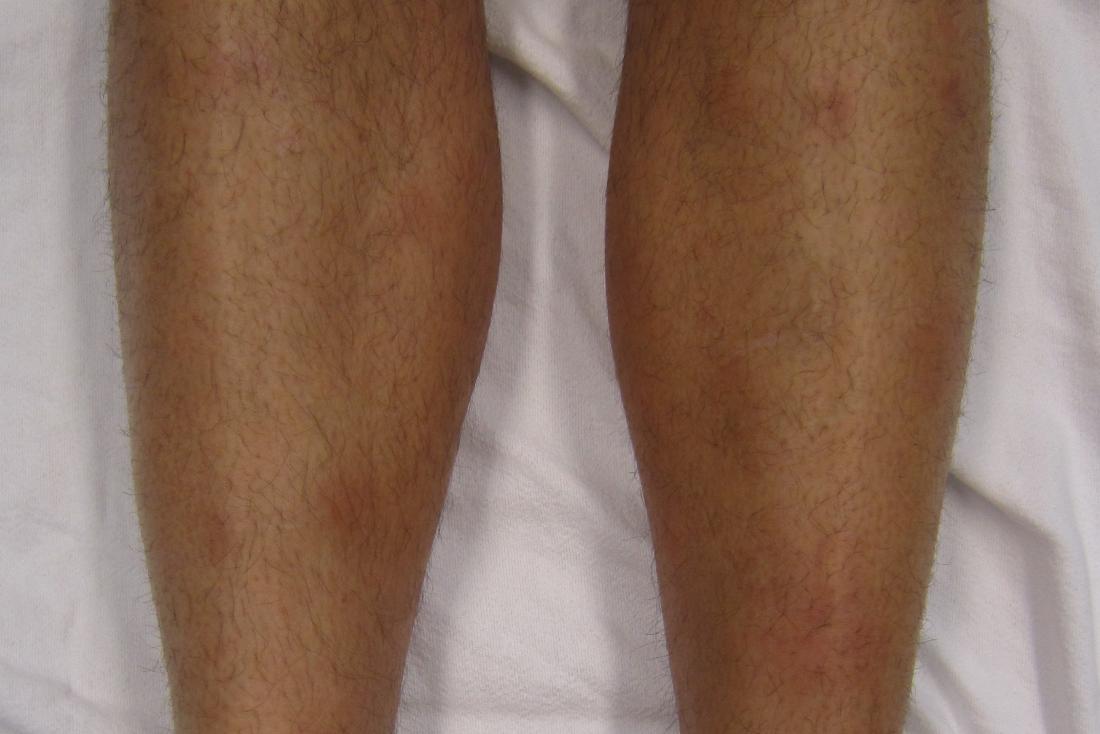 Photographs of both thighs showing swelling of the (a) right and (b)