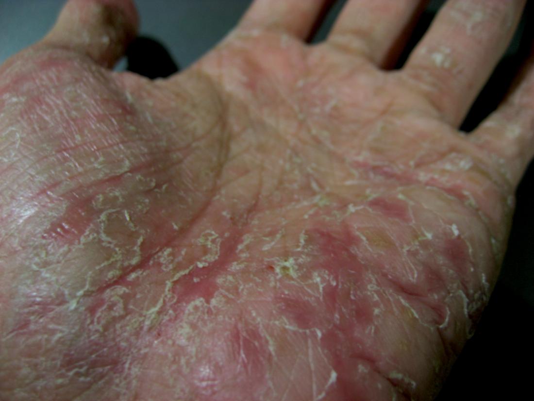 Dyshidrotic Eczema Symptoms Causes And Treatment