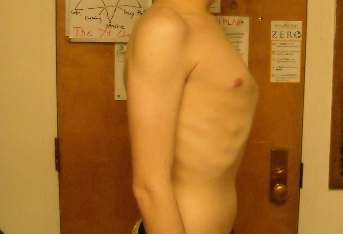 Pigeon chest is when the breastbone pushes outward. Image credit: Tolson411, (2010, February 13)