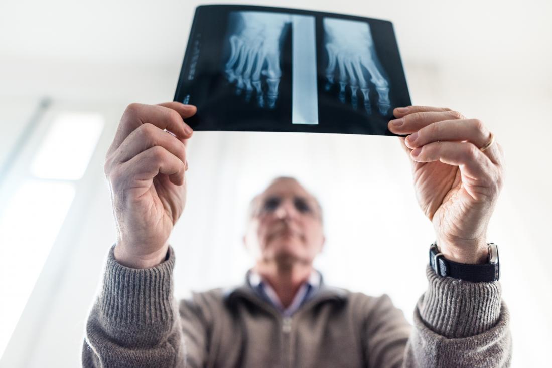 Mature man holding x-ray of foot bones.