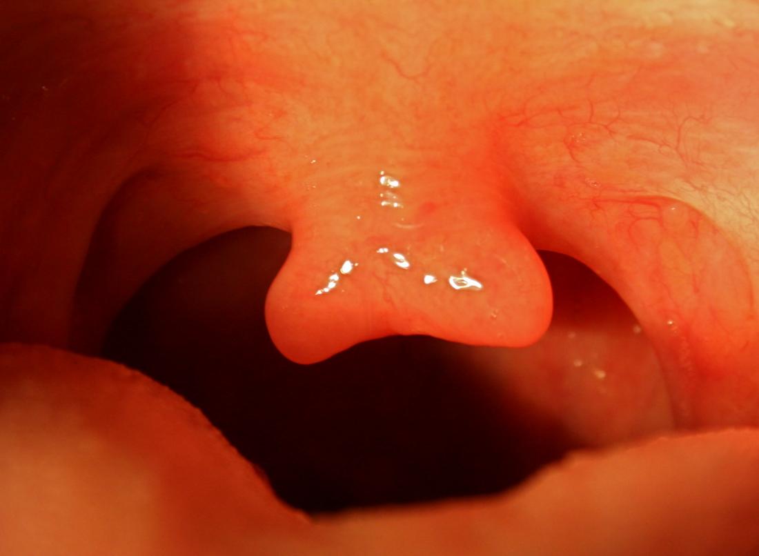 Bifid uvula. Image credit: Solepole, (2008, July 7th.)