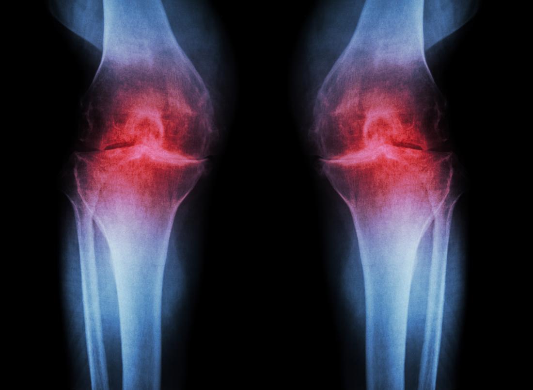 Osteoarthritis