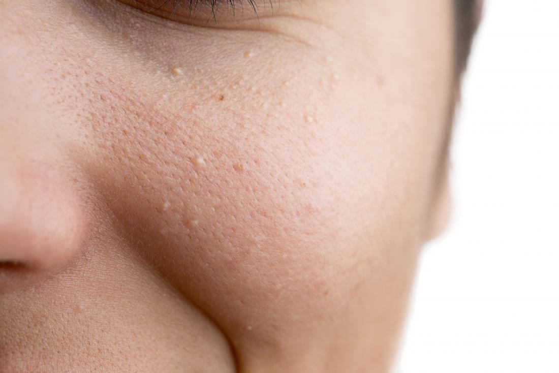 Clear Liquid Bumps On Face   Milia On Woman S Cheek 