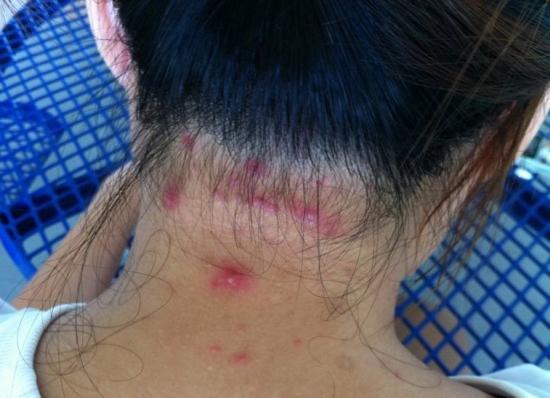 Scalp acne natural treatment