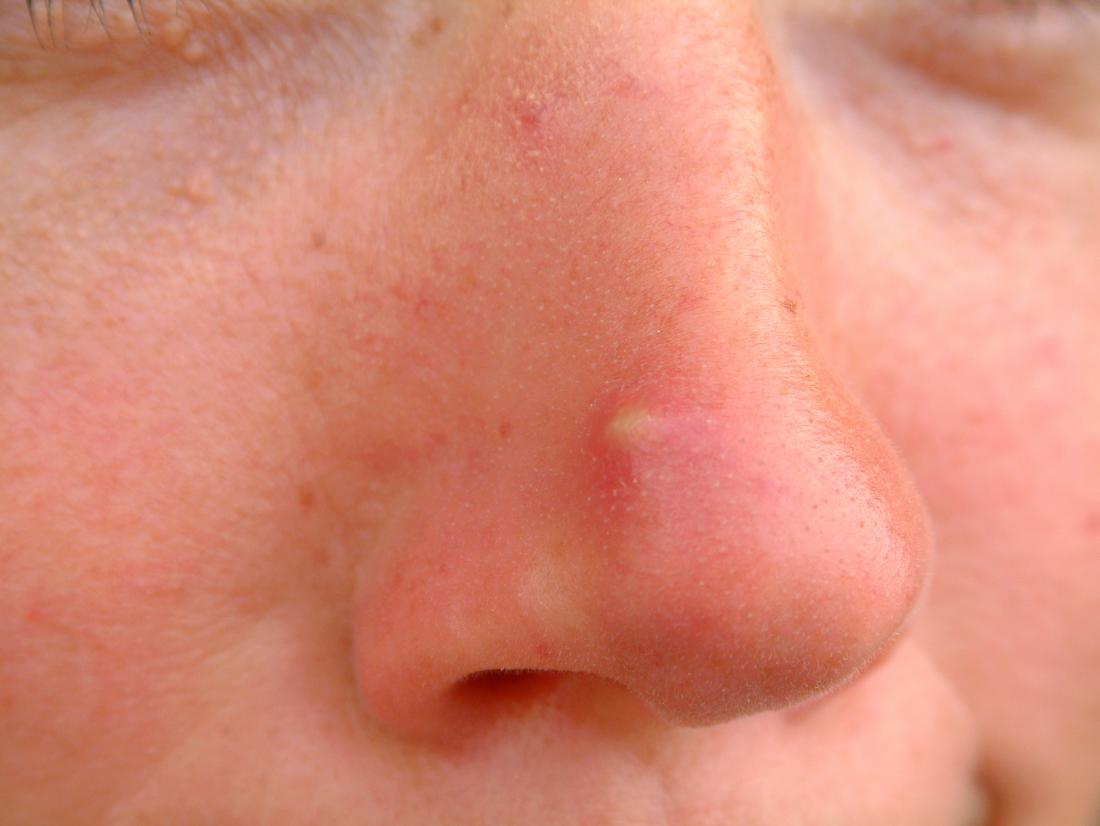 Nose acne: Causes, treatment, and remedies