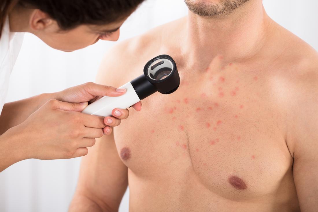How to get rid of body acne: Causes and best remedies 1