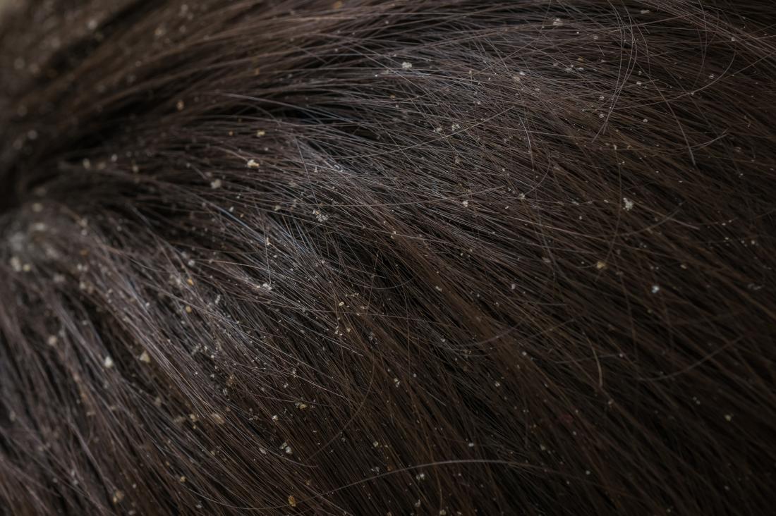 Severe Dandruff Flakes