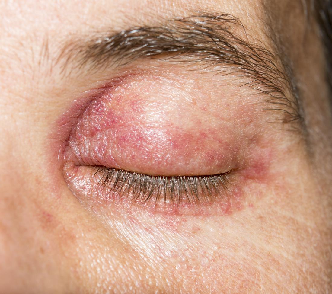 redness-on-eyelids-causes-and-treatments-for-red-dots