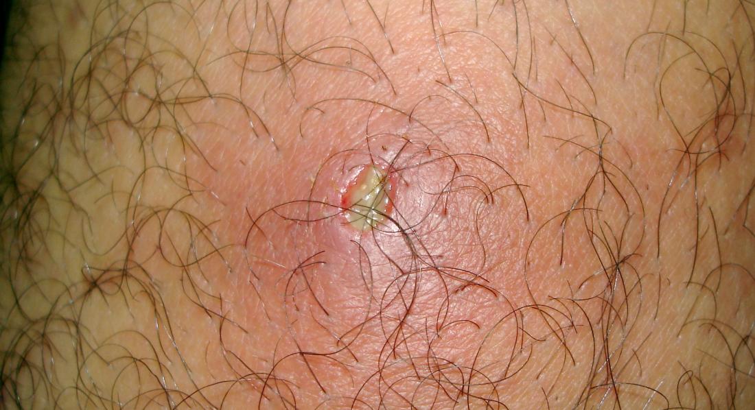 A boil or furuncles on the buttocks <br>Image credit: MGA73bot2, 2012</br>