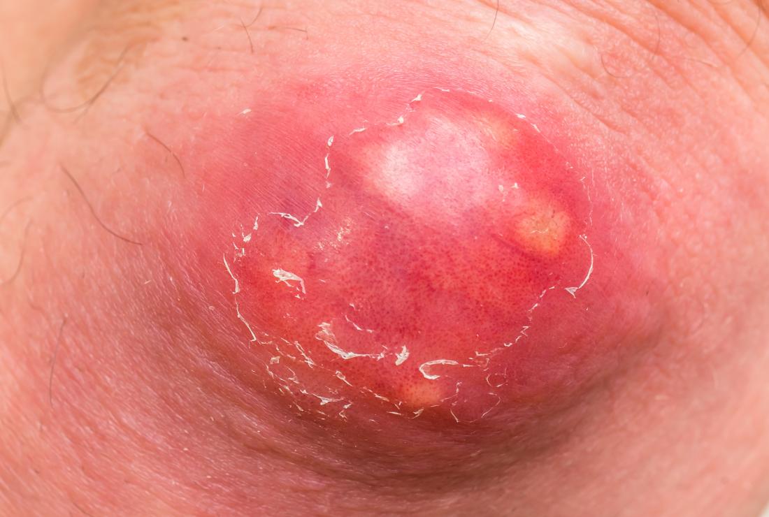 Boil In Crack Between Buttocks Rash