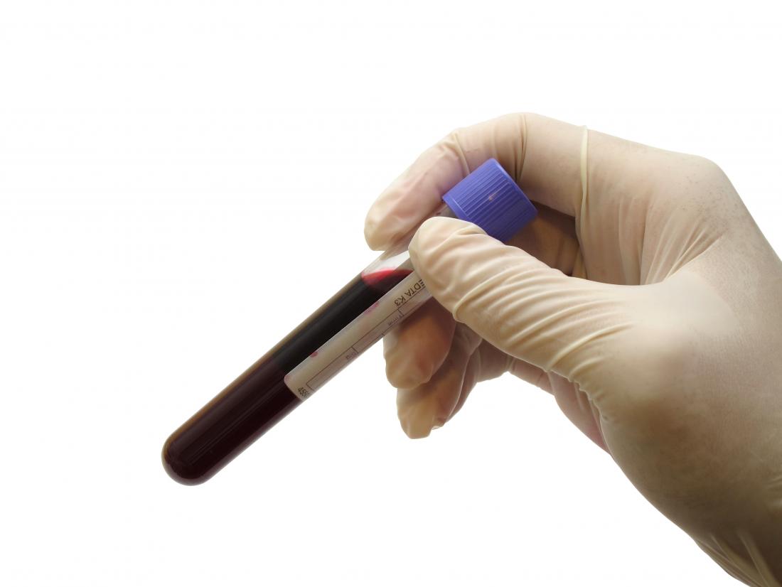 Blood in a test tube which may reveal smoldering multiple myeloma