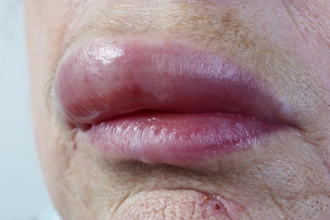 Swollen Lips Causes And Treatment