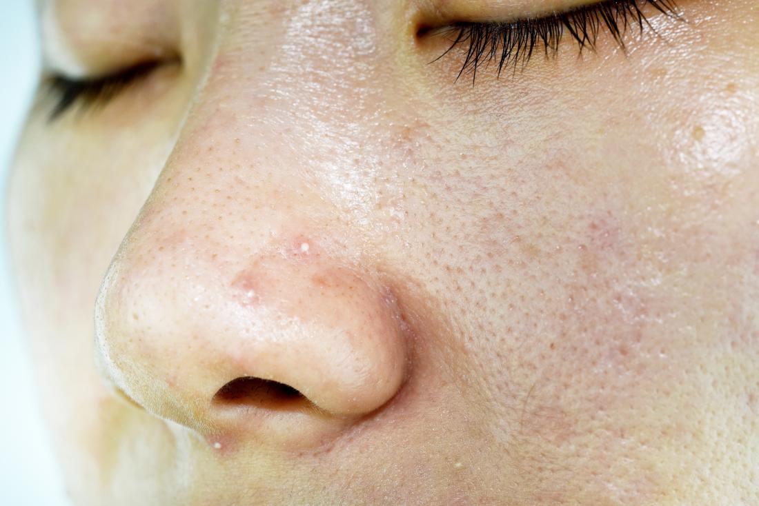 Oily skin: 6 treatments, causes, and prevention