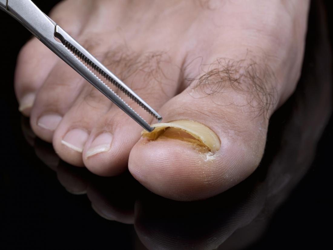 How can I tell if my toenail has a blood clot from injury or fungal  infection Photo  human