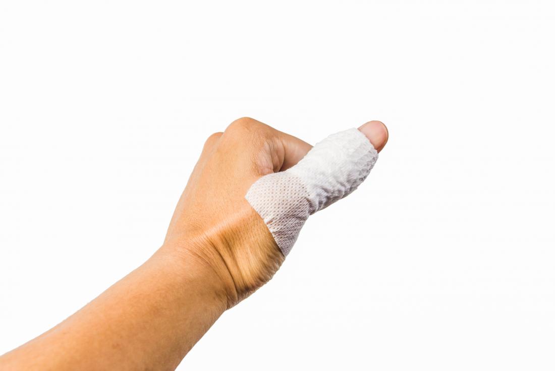 Sprained thumb: Treatment, recovery, and symptoms