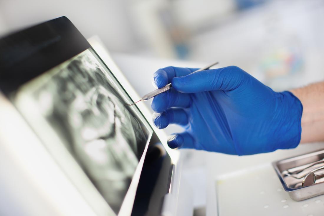 Dentist about to perform periodontal surgery pointing at teeth and gum x-ray on a screen, with surgical tools