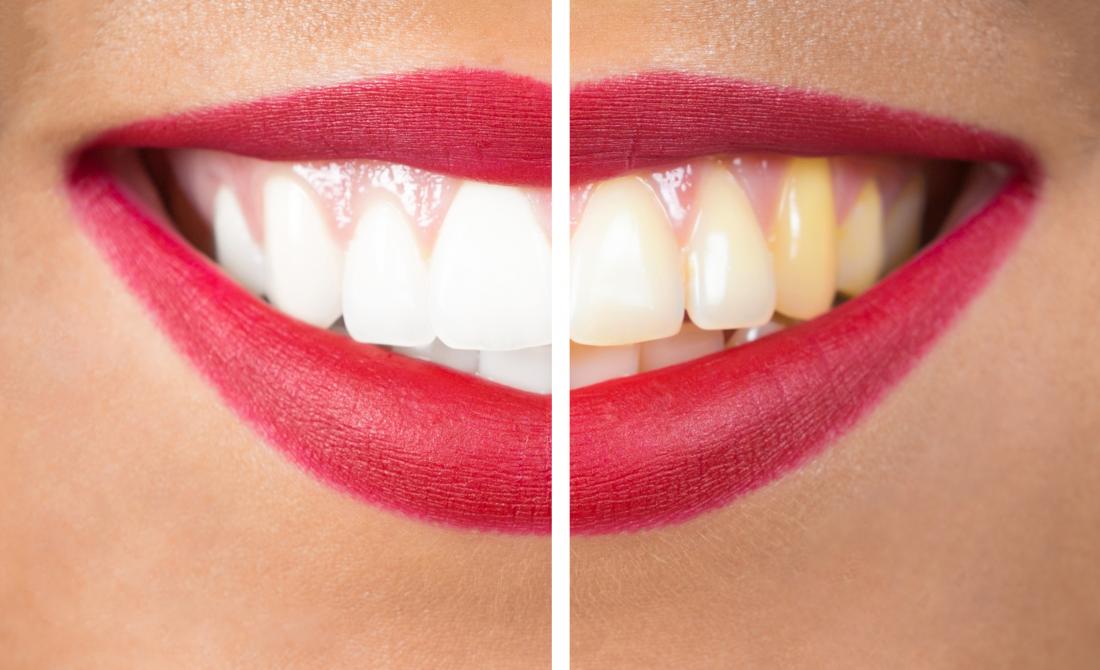 diy teeth whitening strips without baking soda