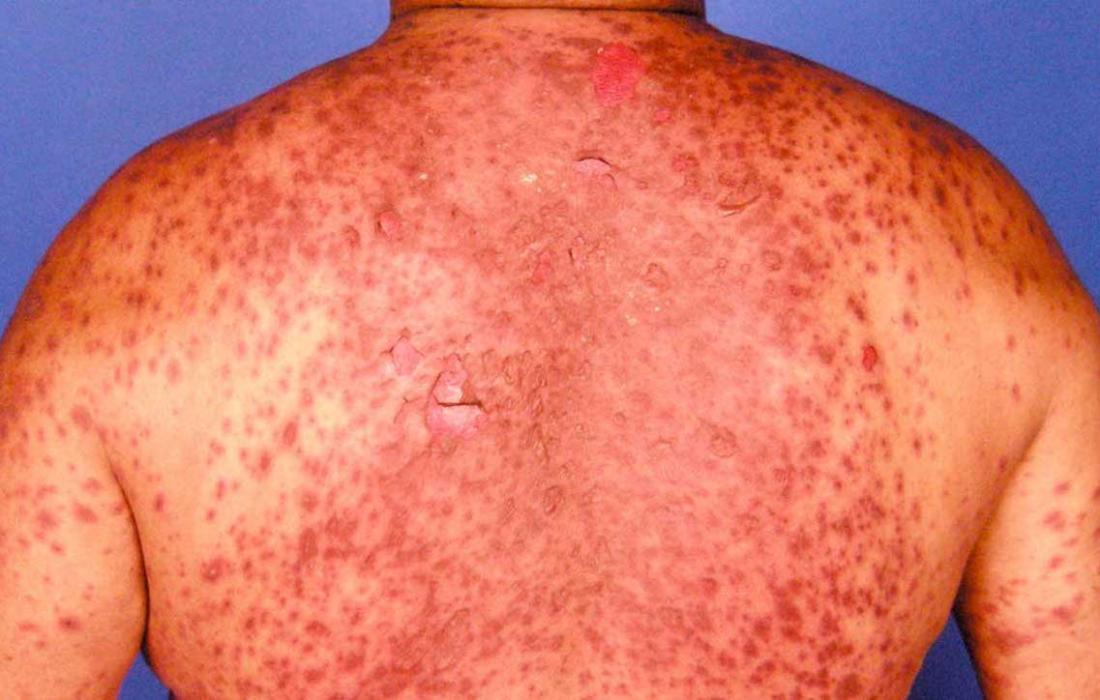 what does lamotrigine rash look like