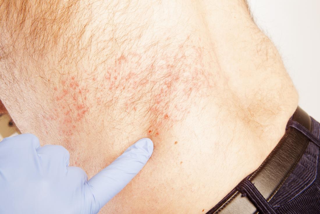 Shingles Rash Under Armpit