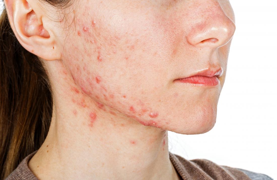 18 Face Bumps You Get Under Your Skin and How to Get Rid of Them