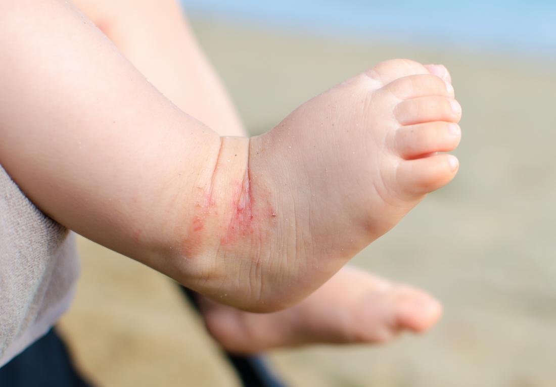 Eczema on the foot of a child