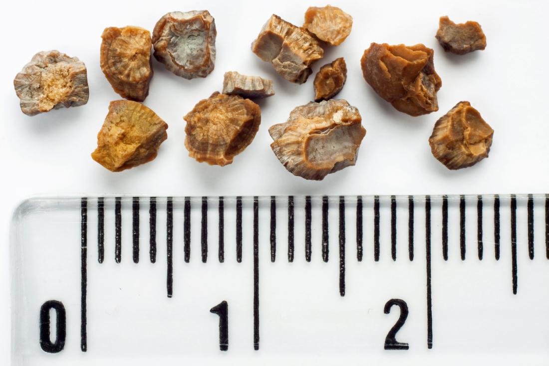 Kidney stones against ruler.