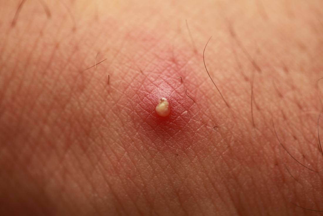 pimple like sores on body