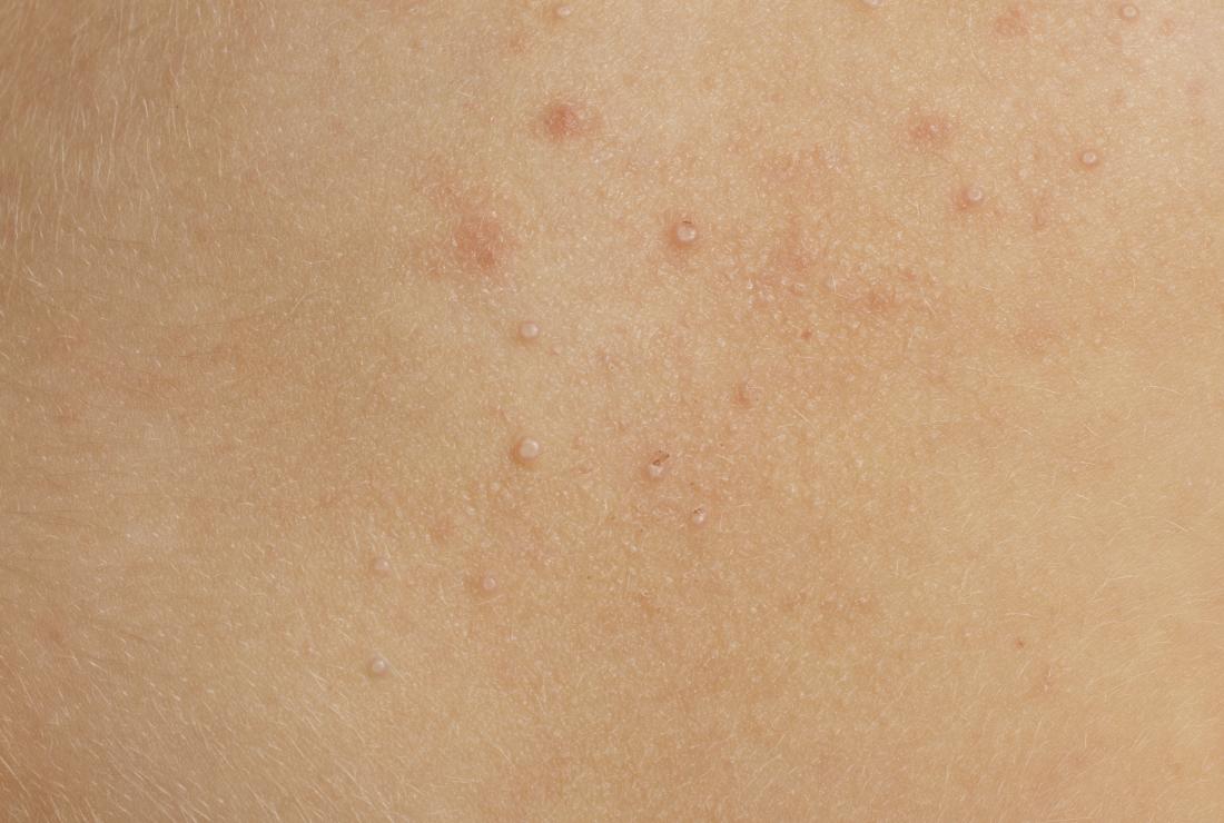 mælk drivhus Lagring White spots on foreskin: Causes, symptoms, and treatment