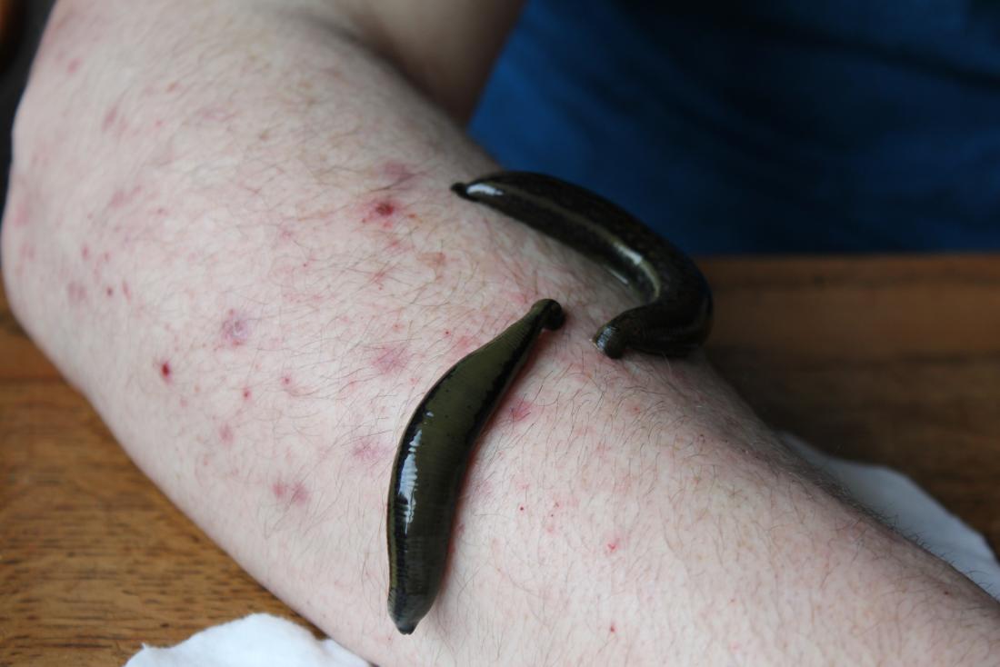 leeches on wounds