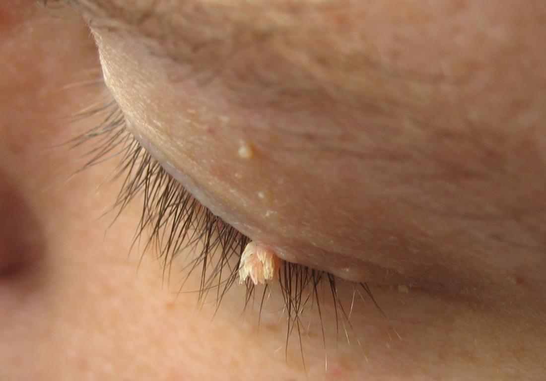 papilloma eyelid