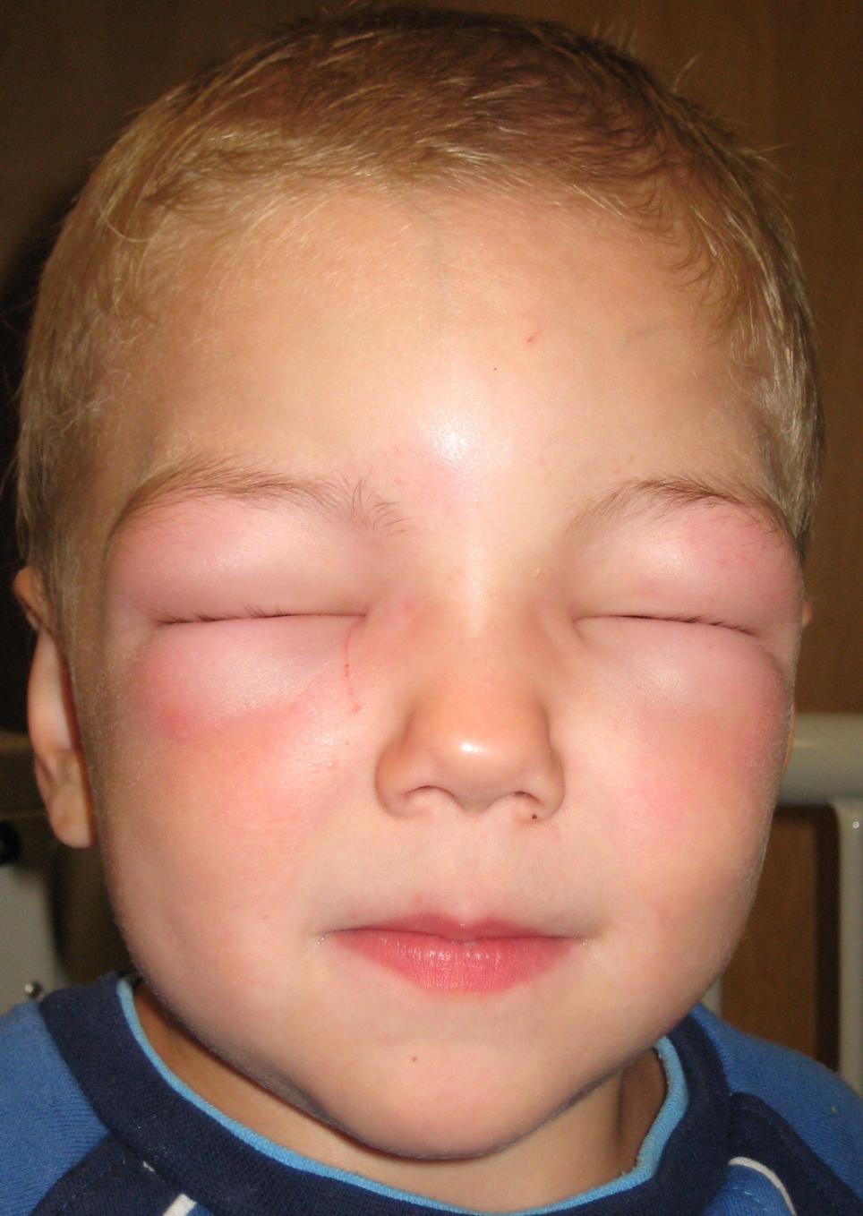 How to treat allergic reaction rash on face