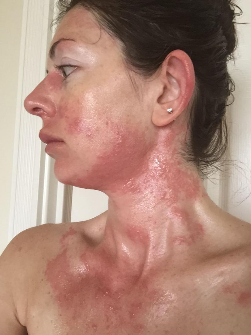 Allergic reaction to face cream symptoms